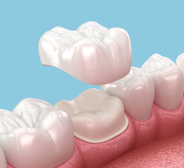 understanding-dental-crowns-and-bridges-what-they-are-and-how-they-work